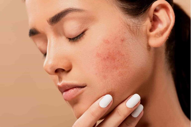Why you can suffer more from pimples in winter